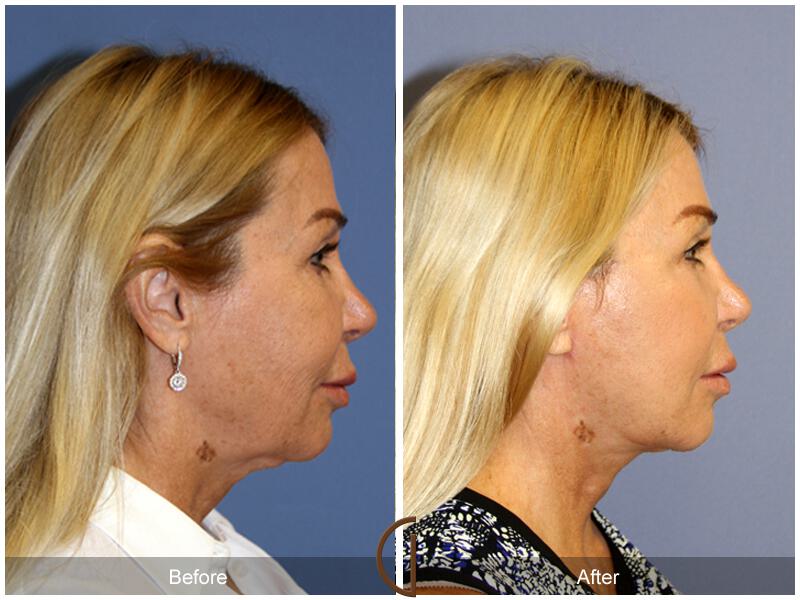 Facelift Fifties Before & After Photo