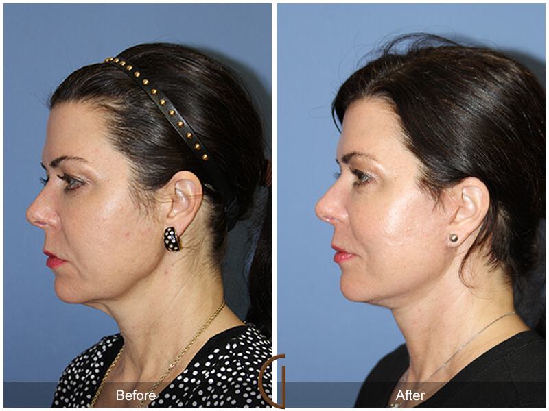 Facelift Fifties Before & After Photo