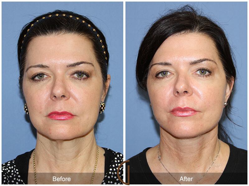 Facelift Fifties Before & After Photo