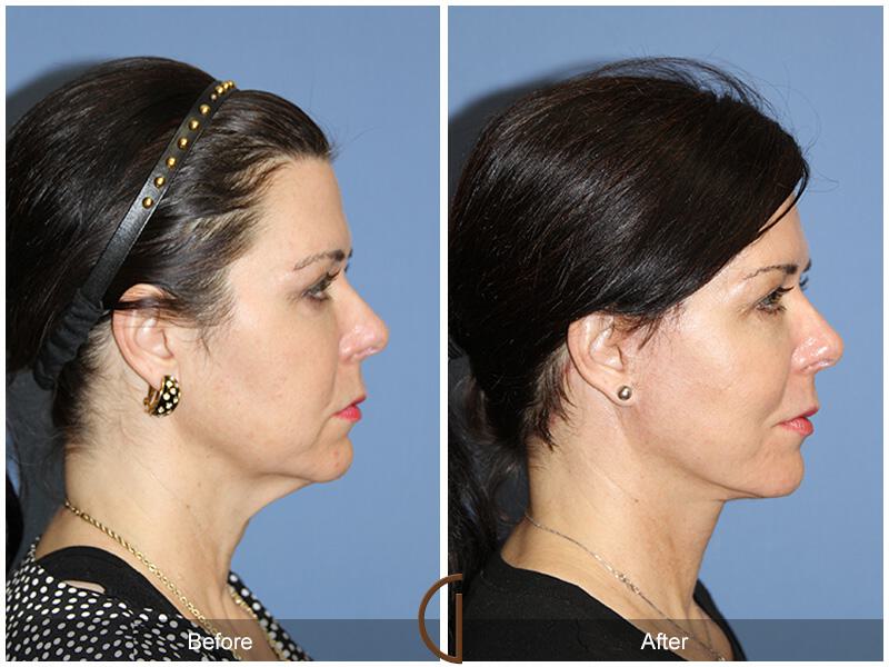 Facelift Fifties Before & After Photo