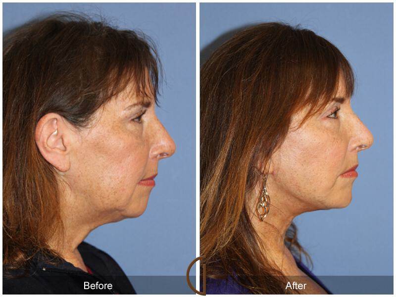 Facelift Fifties Before & After Photo