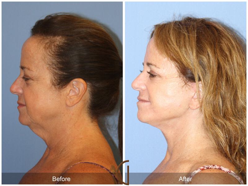 Facelift Fifties Before & After Photo