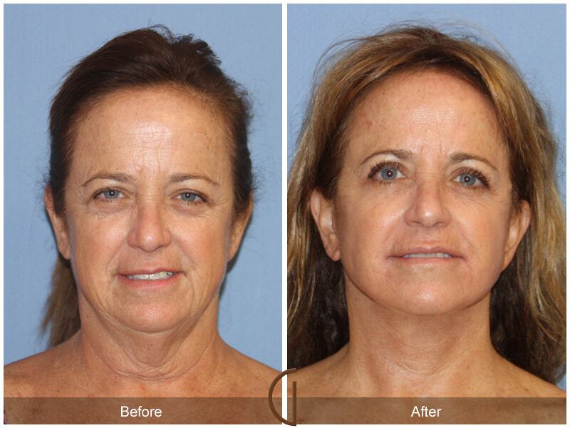 Facelift Fifties Before & After Photo