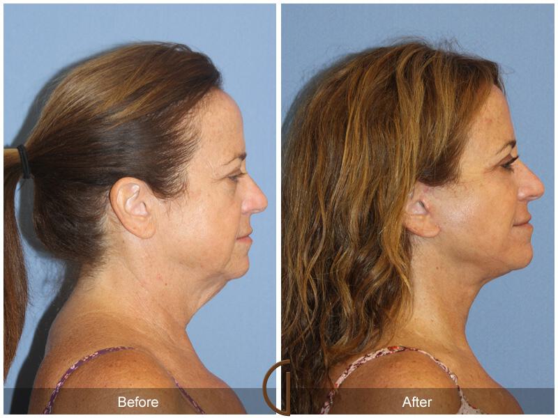 Facelift Fifties Before & After Photo