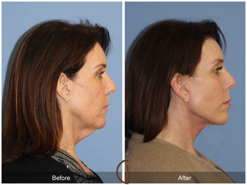 Facelift Fifties Before & After Photo