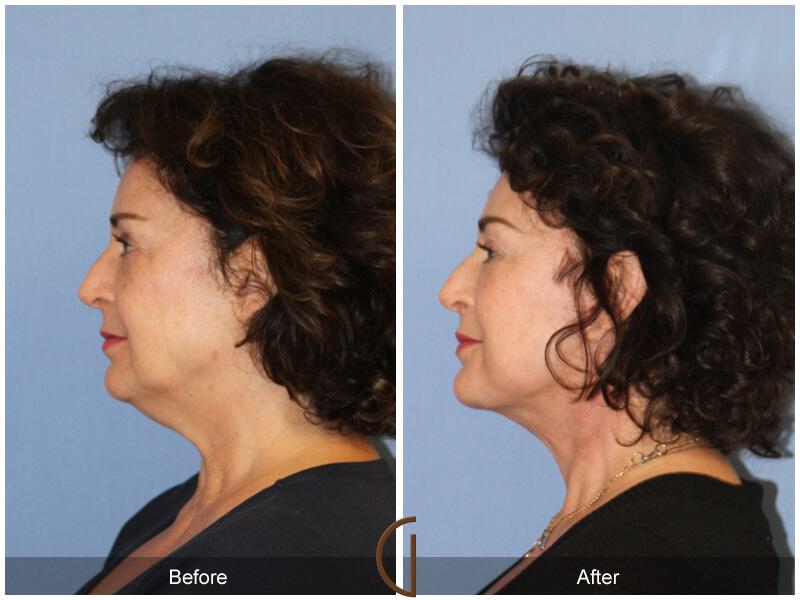 Facelift Fifties Before & After Photo