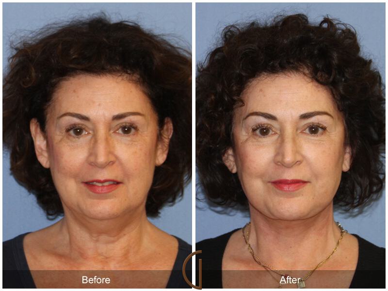 Facelift Fifties Before & After Photo