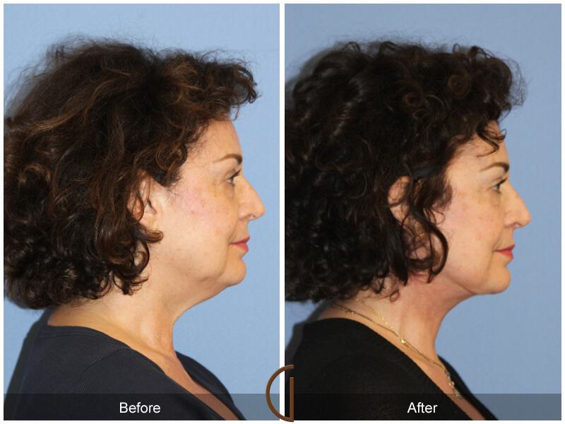 Facelift Fifties Before & After Photo