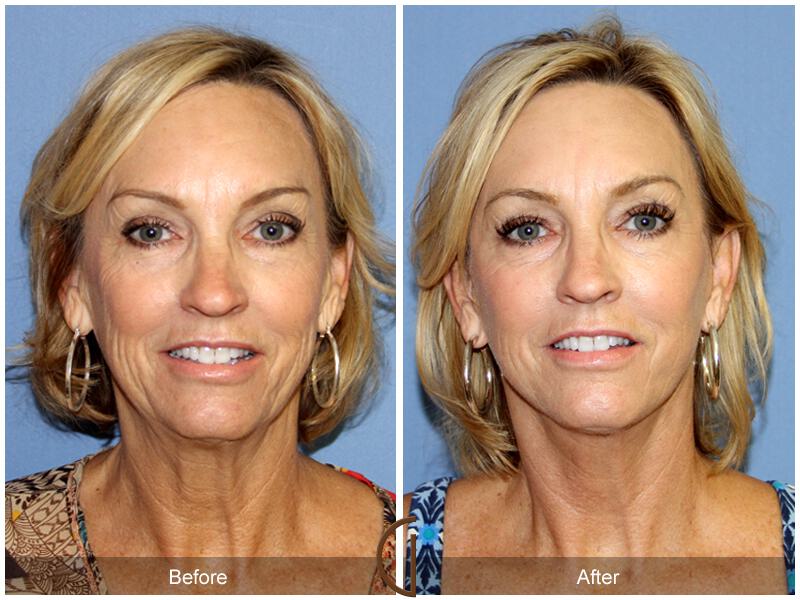 Facelift Fifties Before & After Photo