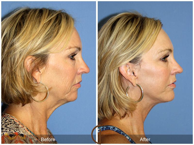 Facelift Fifties Before & After Photo