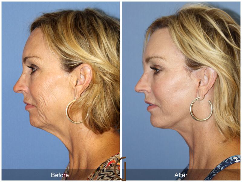 Facelift Fifties Before & After Photo