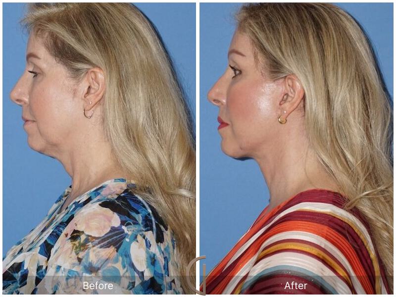 Facelift Fifties Before & After Photo