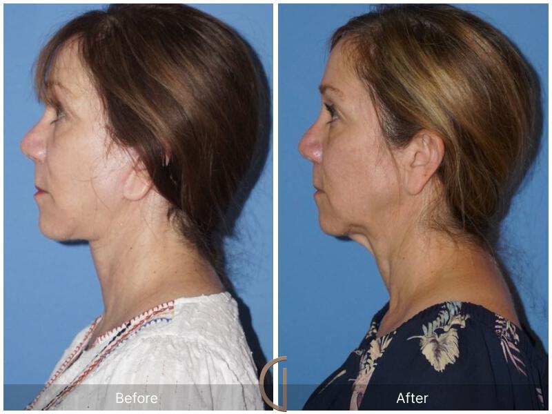 Facelift Fifties Before & After Photo