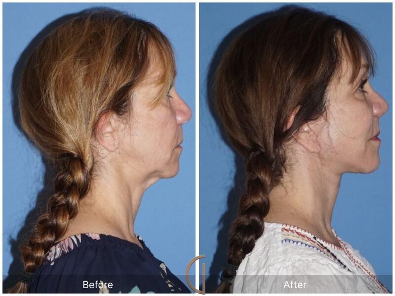 Facelift Fifties Before & After Photo