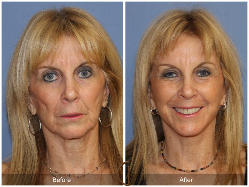 Facelift Sixties Before & After Photo