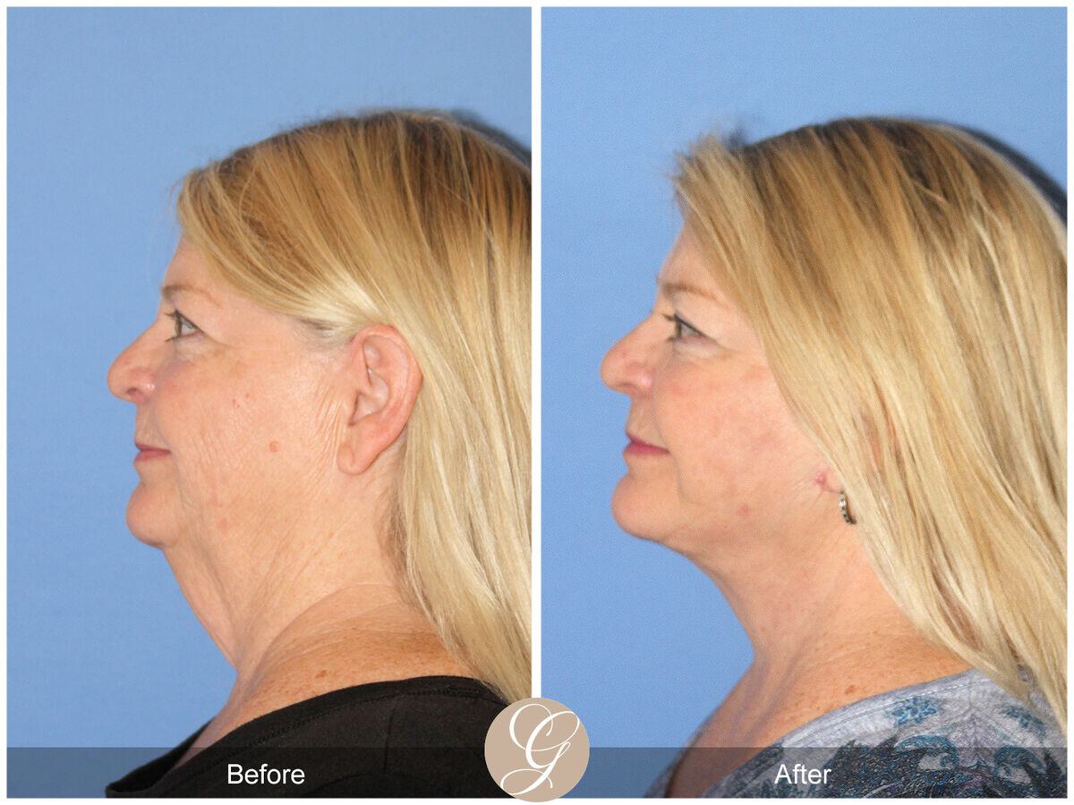 Facelift Sixties Before & After Photo