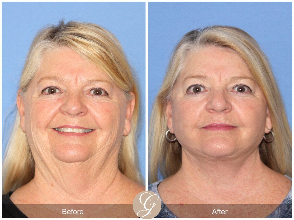 Facelift Sixties Before & After Photo