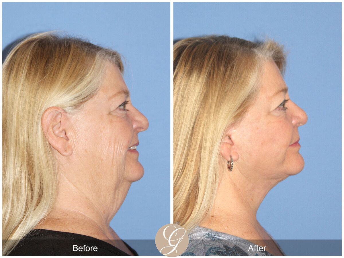 Facelift Sixties Before & After Photo