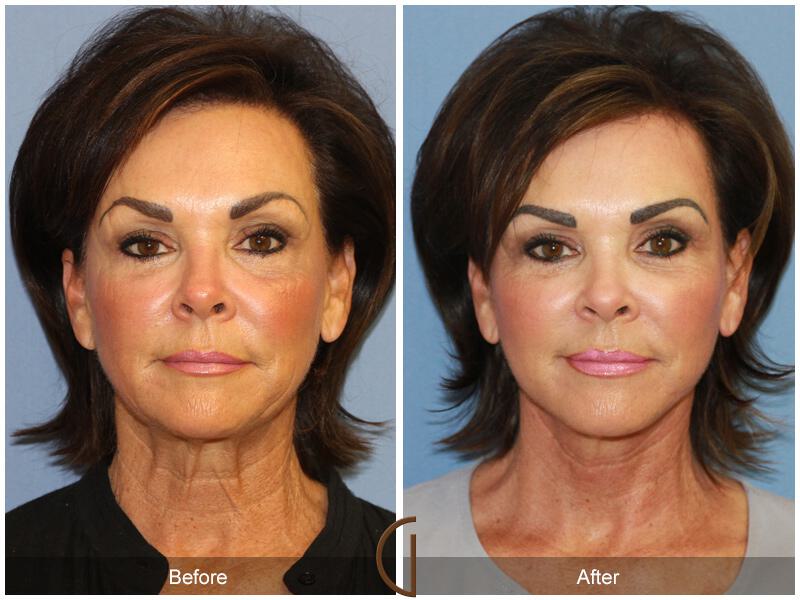 Facelift Sixties Before & After Photo