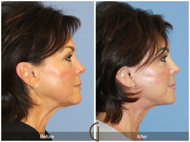 Facelift Sixties Before & After Photo