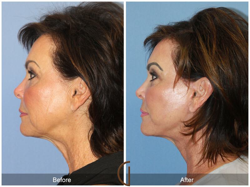 Facelift Sixties Before & After Photo