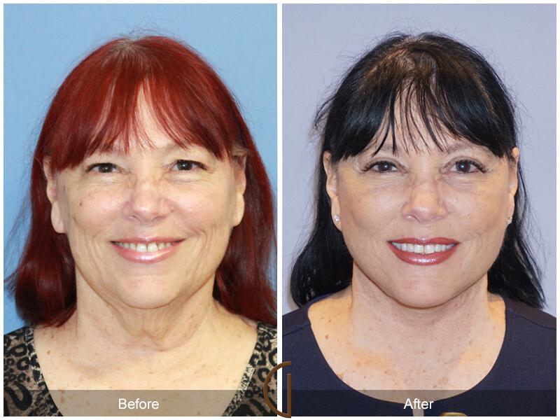 Facelift Sixties Before & After Photo