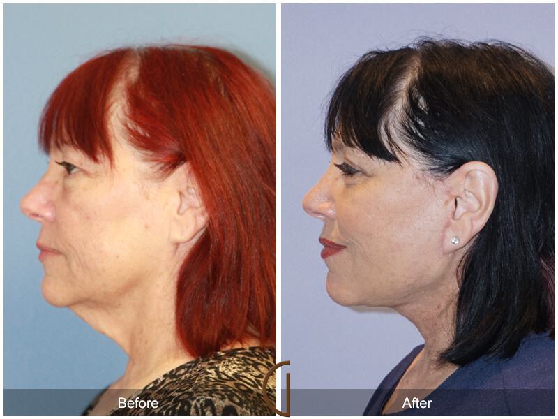 Facelift Sixties Before & After Photo