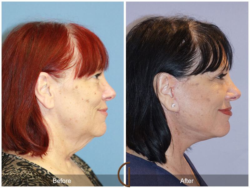 Facelift Sixties Before & After Photo