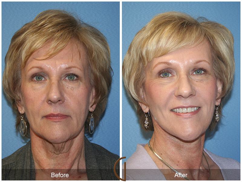 Facelift Sixties Before & After Photo