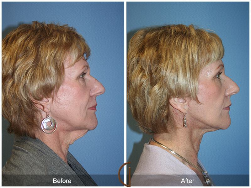 Facelift Sixties Before & After Photo