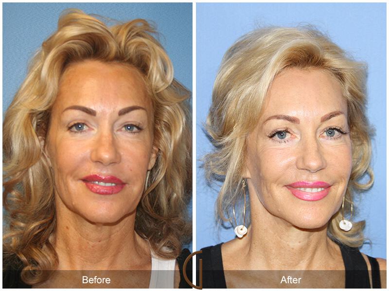 Facelift Sixties Before & After Photo