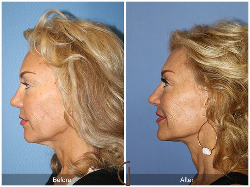 Facelift Sixties Before & After Photo