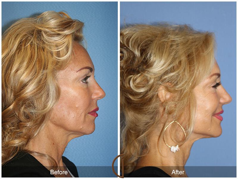 Facelift Sixties Before & After Photo