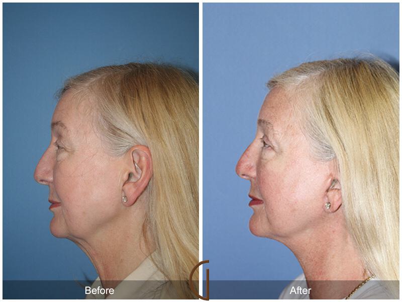 Facelift Sixties Before & After Photo