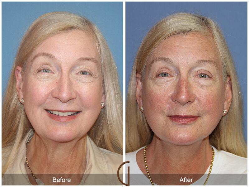 Facelift Sixties Before & After Photo