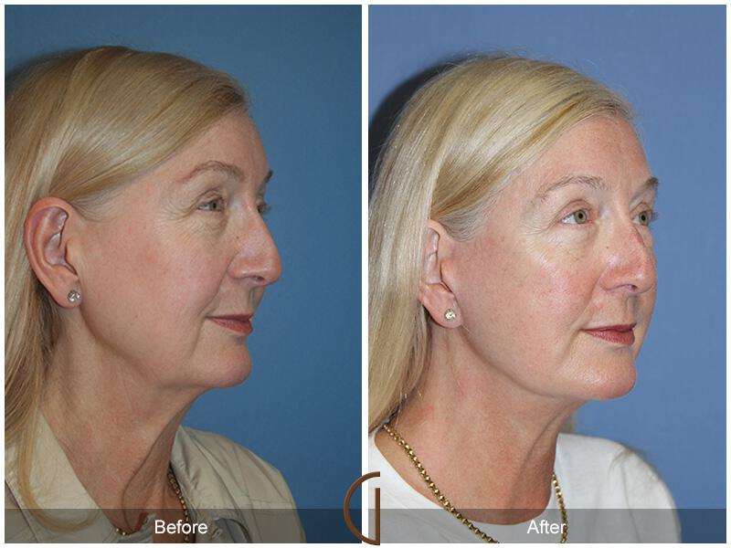 Facelift Sixties Before & After Photo