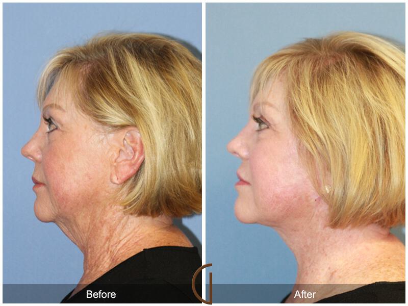 Facelift Sixties Before & After Photo