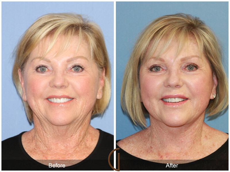 Facelift Sixties Before & After Photo