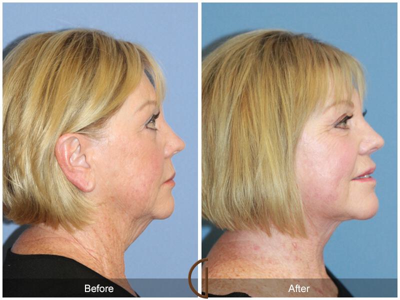 Facelift Sixties Before & After Photo