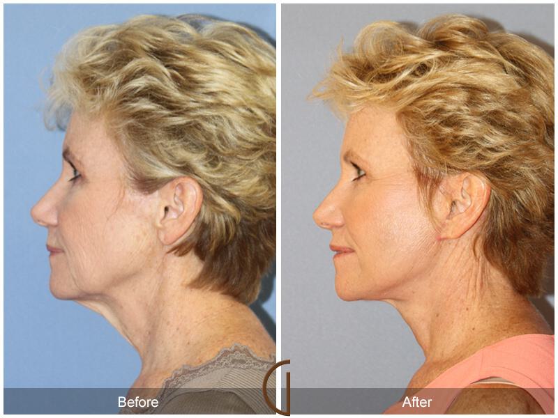 Facelift Sixties Before & After Photo