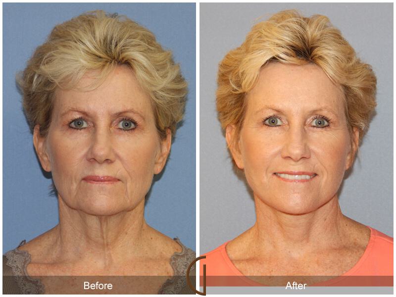 Facelift Sixties Before & After Photo