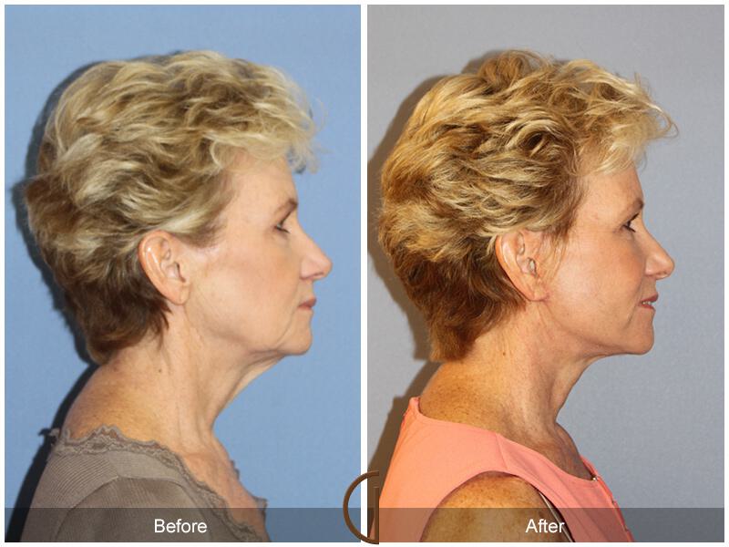 Facelift Sixties Before & After Photo