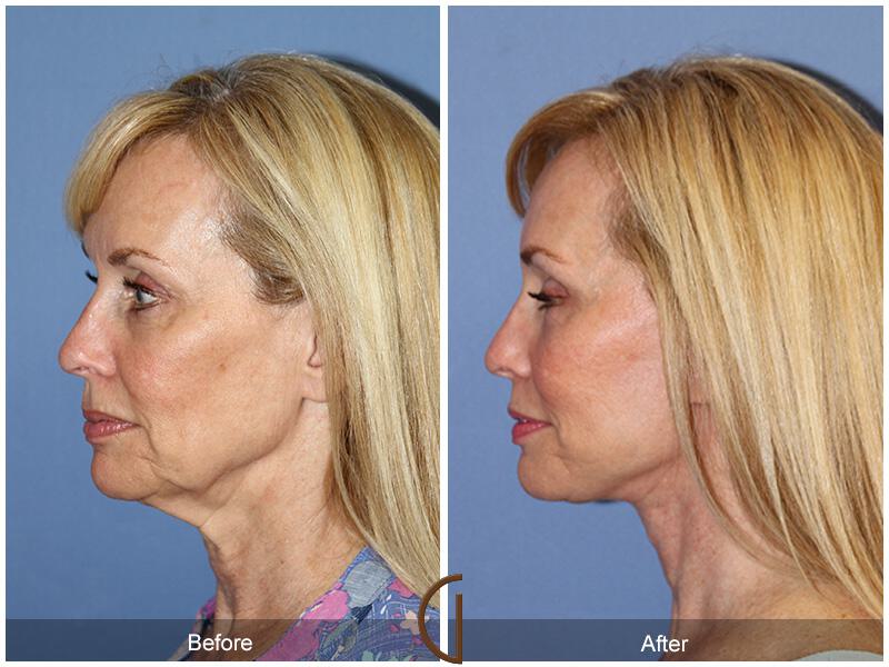 Facelift Sixties Before & After Photo