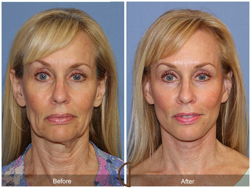 Facelift Sixties Before & After Photo