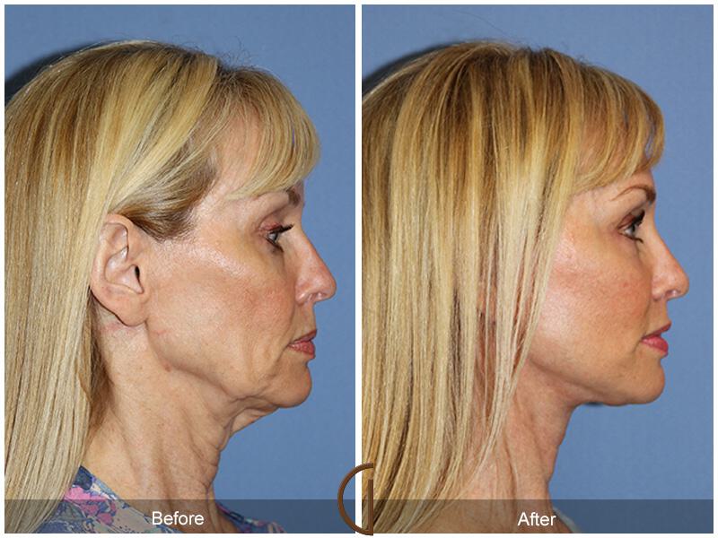 Facelift Sixties Before & After Photo