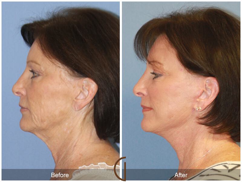 Facelift Sixties Before & After Photo