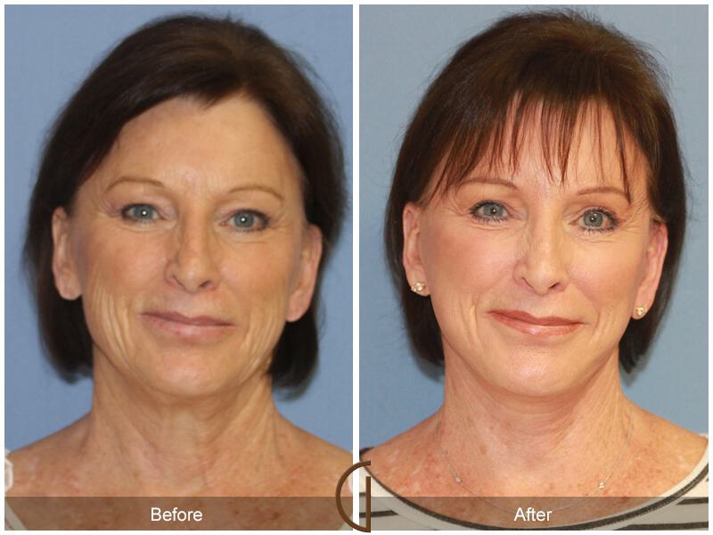 Facelift Sixties Before & After Photo