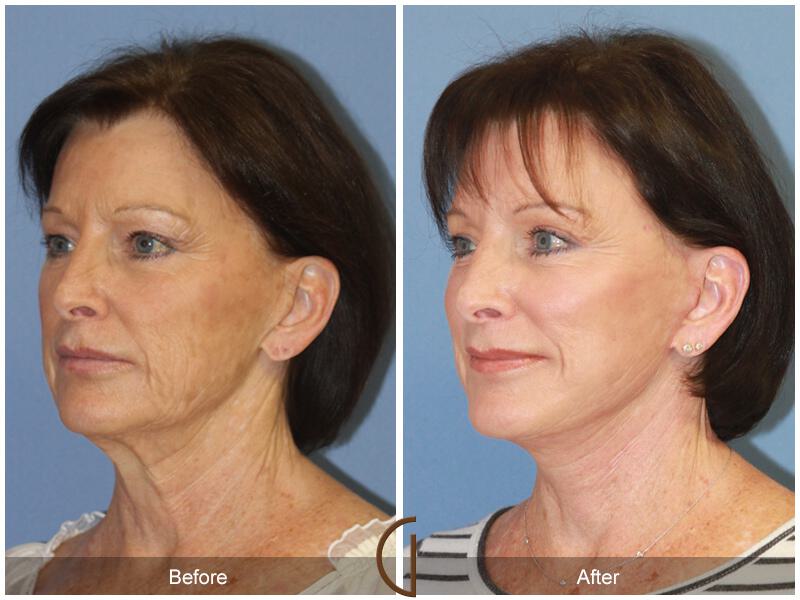 Facelift Sixties Before & After Photo