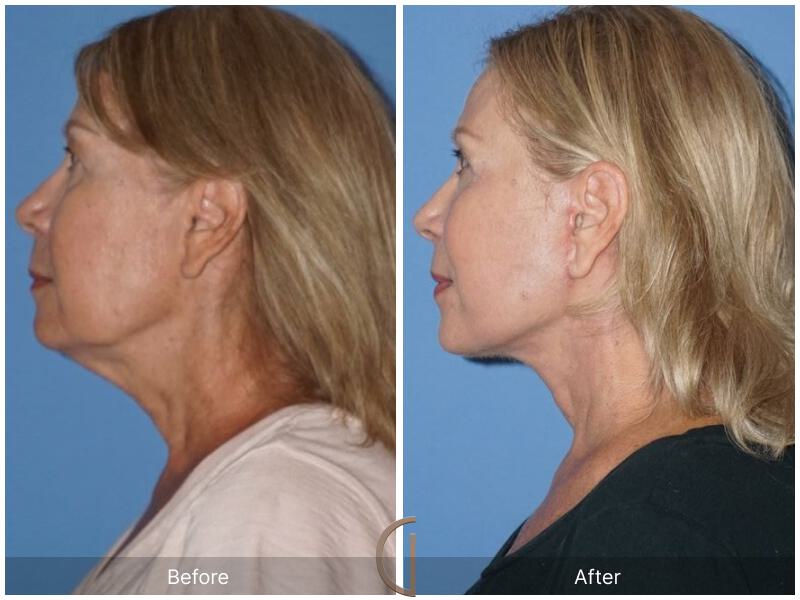 Facelift Sixties Before & After Photo