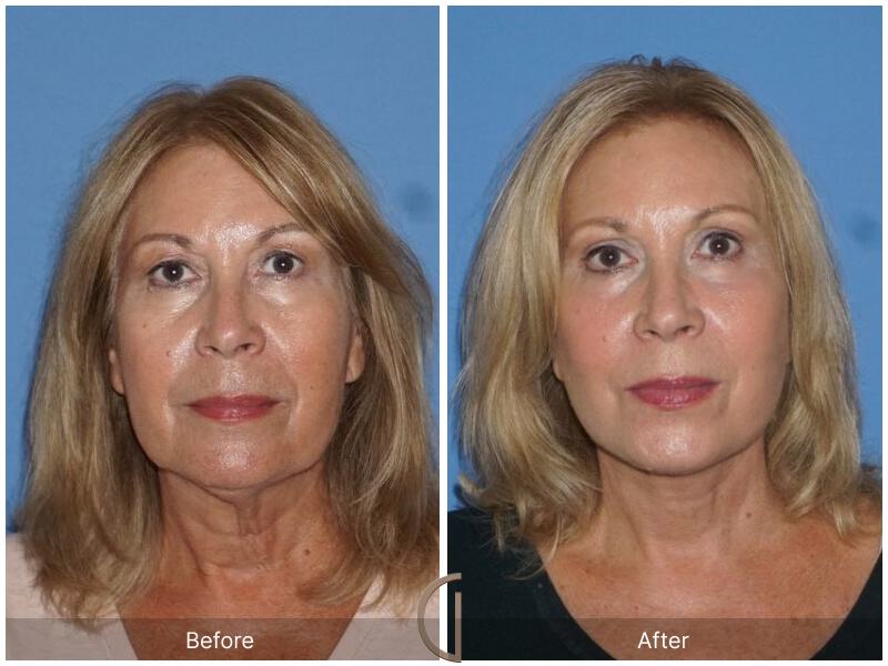 Facelift Sixties Before & After Photo